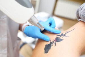 cosmetologist removes the tattoo