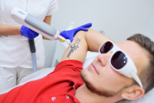 A cosmetologist remove the patient tattoo