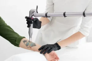 Beautician using laser device remove unwanted tattoo from female arm concept erasing.